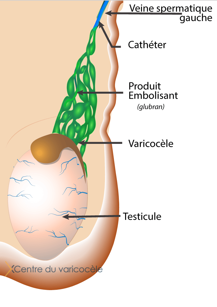 Varicocee TRAITEMENT DU VARICOCELE